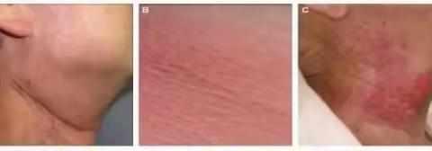 放疗后，皮肤会怎样？