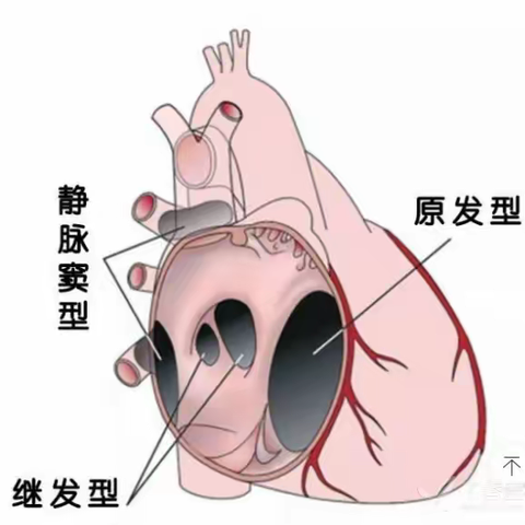 房间隔缺损