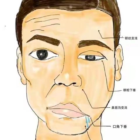 口角歪了？眼睛闭不上了？中西医结合康复助你重绽自信笑容！