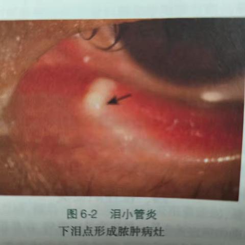 认识泪小管炎