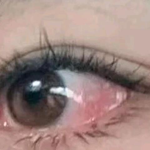 呵护双眼，远离过敏性结膜炎