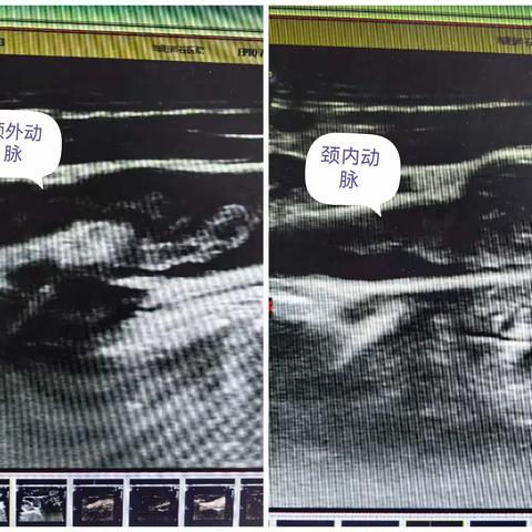 颈动脉斑块超声造影分享（2）