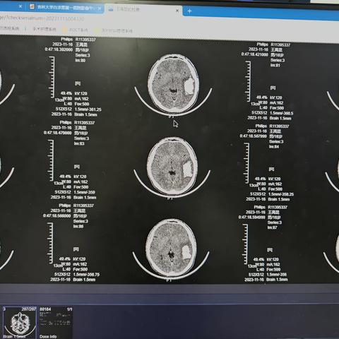 2023-11-17左侧颞叶动静脉畸形栓塞    王禹昆，男，18岁，突发失语1天