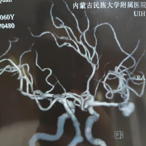 2024-6-3栓塞  张广全，男，60岁，住院检查发现右侧大脑中动脉分叉动脉瘤