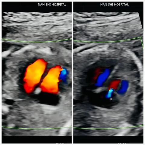 胎儿三尖瓣反流