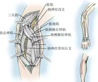 桡管综合征（肘关节部）