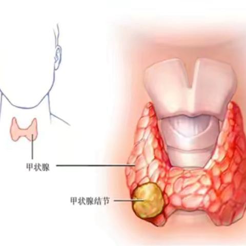 普外科患教会---甲状腺知识健康宣教