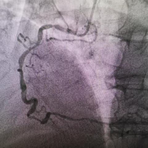 冠脉精准治疗病例二