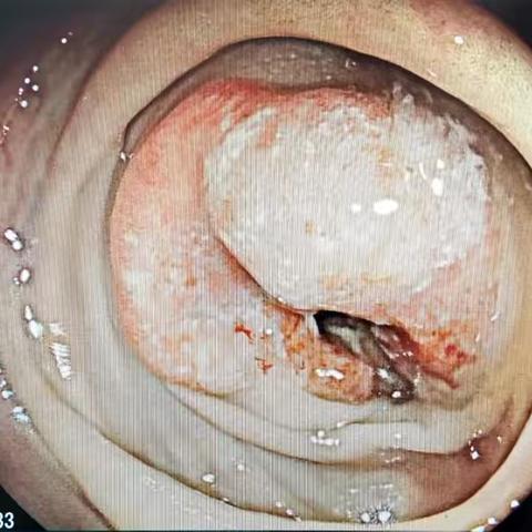 一旦有明显症状往往已是中晚期！这几类人群建议定期做胃肠镜检查