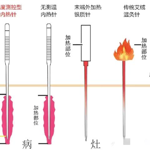 内热式针灸治疗仪，科技与传统的完美融合