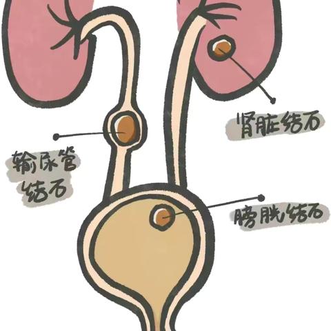 泌尿系统结石知多少？