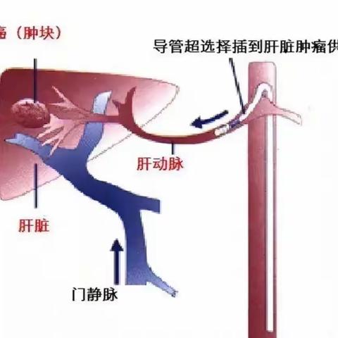 肝脏肿瘤的治疗“利器” （HAIC）
