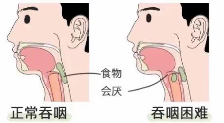 IOE（间歇经口至食管管饲法）来帮您摆脱“象鼻子”