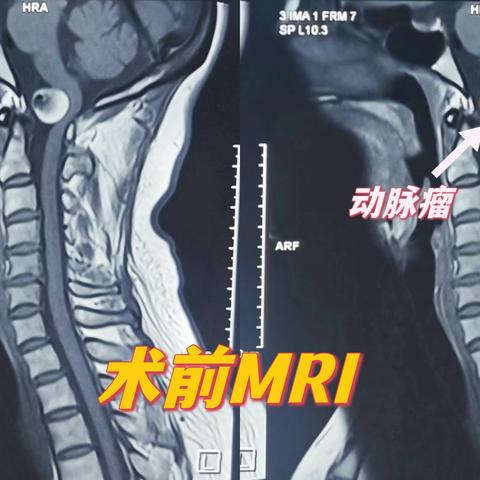 延髓区域动脉瘤，神外专家巧摘除