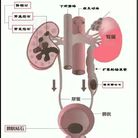 酷暑盛夏，如何预防泌尿系结石