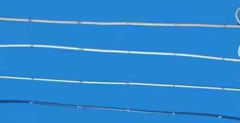 泌尿外科术后篇之——双J管术后的注意事项