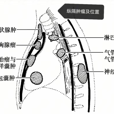 【纵隔肿瘤之胸腺瘤病例分享】从诊断到康复的全程记录