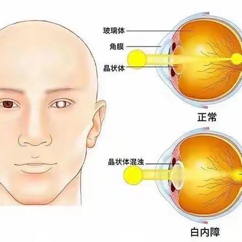 带您了解白内障  让您“视”界变清晰