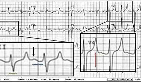 5种可能致命的异常心电图特征