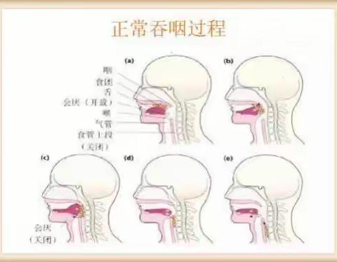 脑卒中吞咽障碍患者健康教育