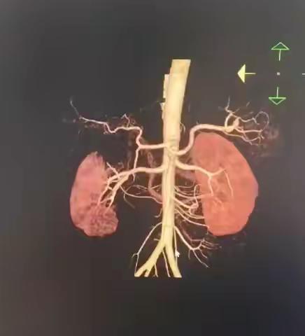 近日放射综合血管介入完成一例“肾梗死、肾动脉闭塞血管开通术病人