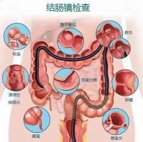 注水结肠镜在临床中的应用