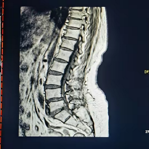 火龙罐在腰椎术后患者中的应用