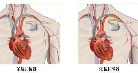 起搏器术后六问六答