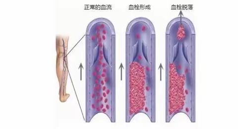 如何预防静脉血栓