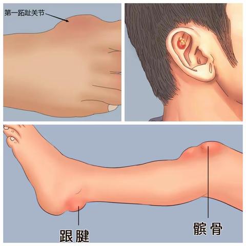 痛风发作不可怕、尽早就医效更佳！