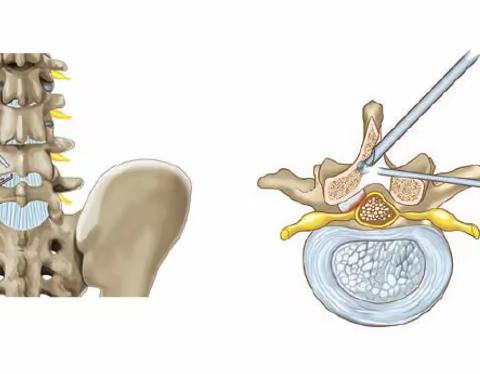 十年磨一剑！我院骨伤科成功开展单侧双通道脊柱内镜（UBE）下腰椎融合内固定术