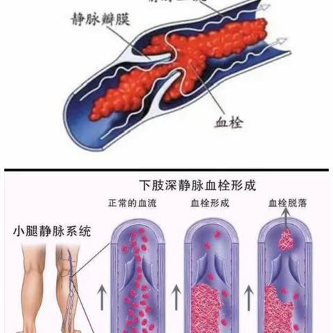 【健康科普】关于深静脉血栓，您了解多少