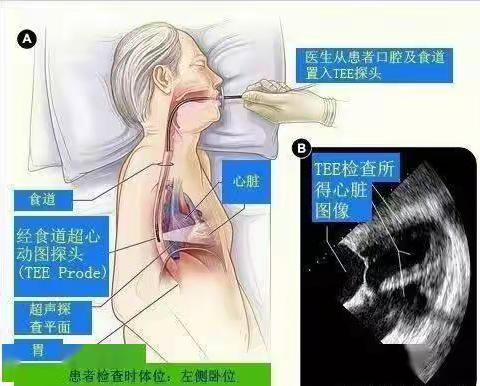 食道超声检查的宣教篇