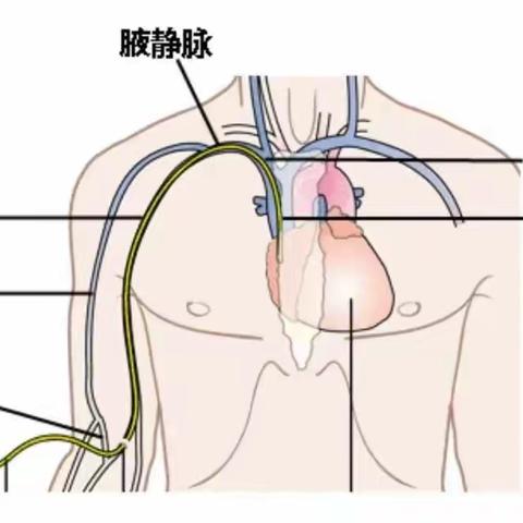 开启便捷输液的新时代