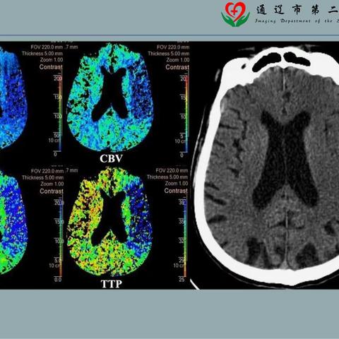 通辽市二院开展脑卒中平扫+CTA+CTP一站式成像