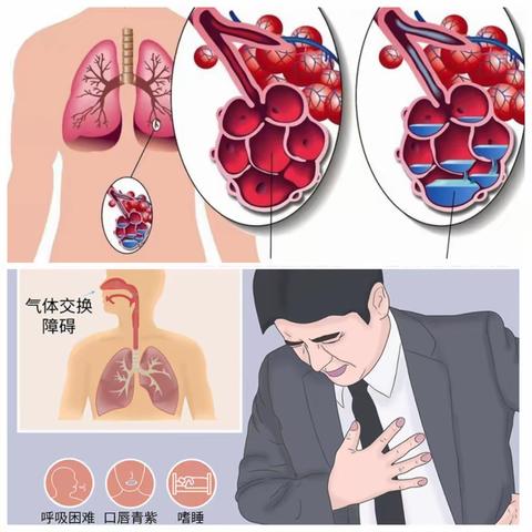 呼吸内科常见疾病系列——呼吸衰竭