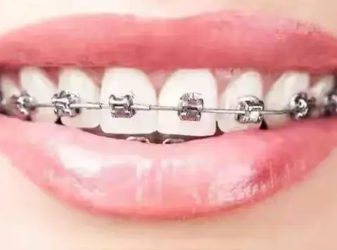正畸初戴牙套注意事项
