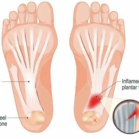 足底筋膜炎的诊断与治疗