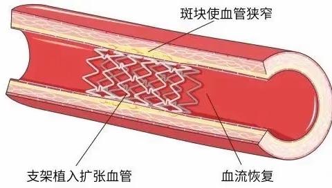 心脏支架长啥样？置入后有什么注意事项？