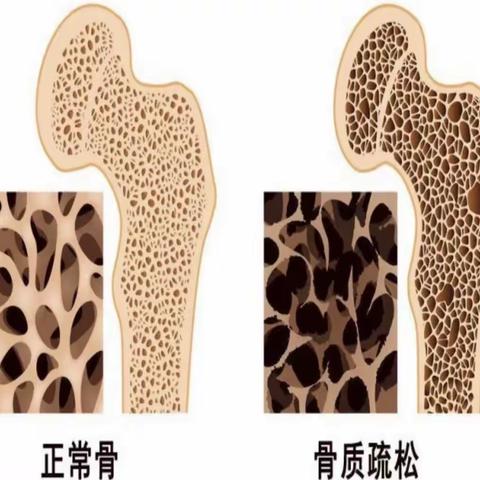 你是否患有骨质疏松？