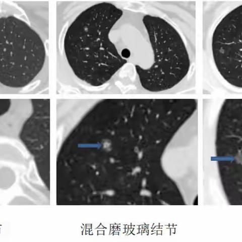 肺结节你能了解多少？