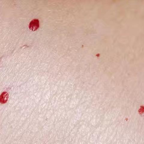 皮肤长了好多小红点，要不要治疗？