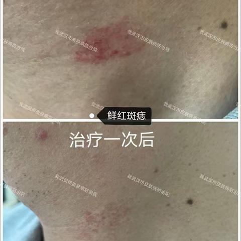 “皮肤血管性疾病大杀器” ——595nm脉冲染料激光