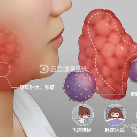 流行性腮腺炎----武汉情智学校健康宣教