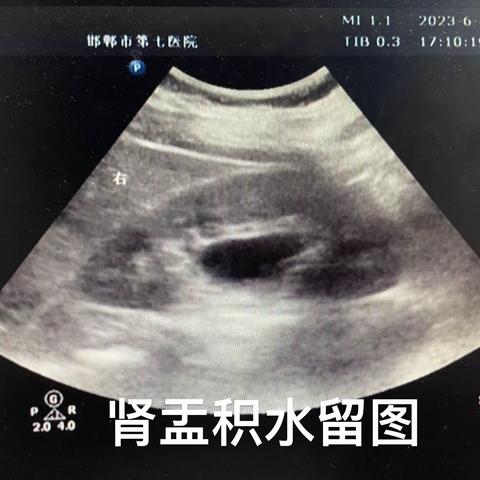 超声科夜班急腹症的常客——泌尿系结石