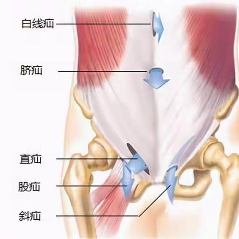 健康科普--疝气科普