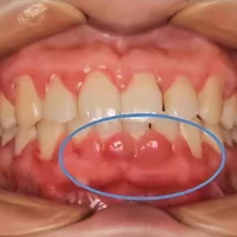 牙龈肿胀难受？有可能是激素在捣乱