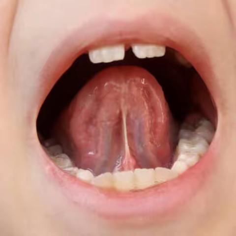 小朋友的唇系带和舌系带短，要做手术吗？