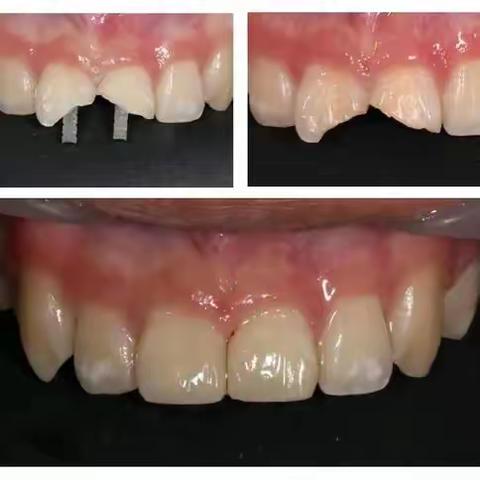 同样是根管治疗，为什么有的牙齿需要打桩?