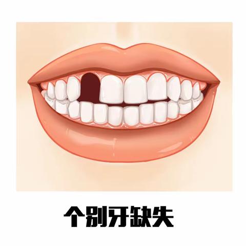 单颗牙缺失，镶牙还是种牙？